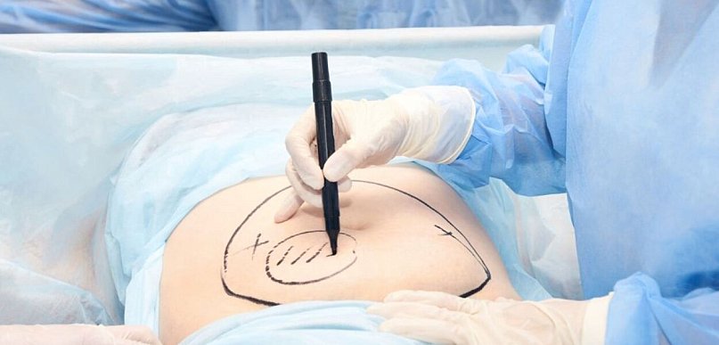 Lipotransfer – przeszczep własnego tłuszczu